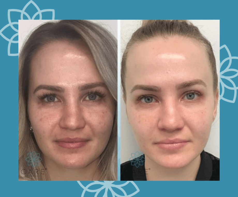 5 Reasons to Try the Bio-LIFT Facial Treatment by CARE Esthetics Sarasota