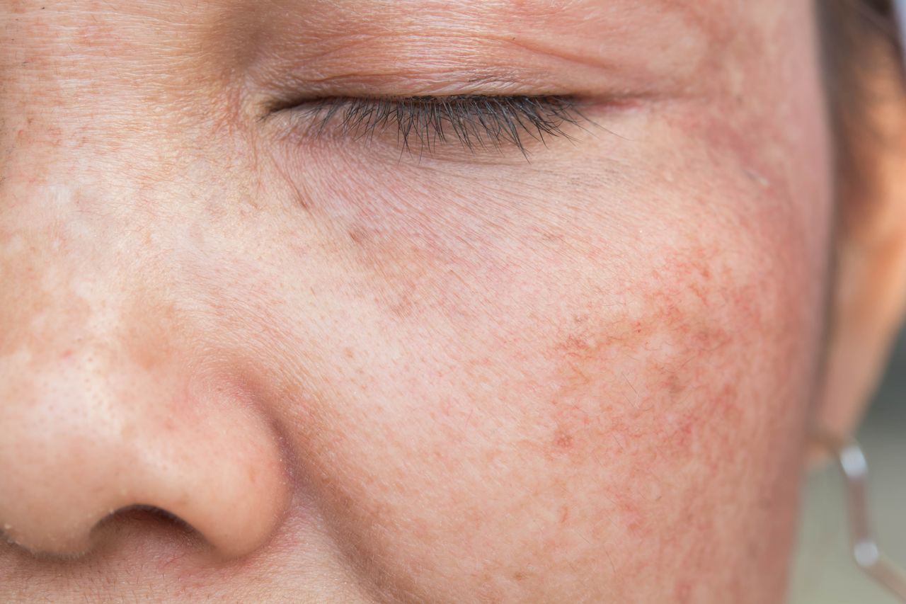 woman's face showing age spots before treatment.