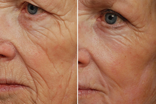 Laser skin resurfacing treatment being administered to a patient's face.