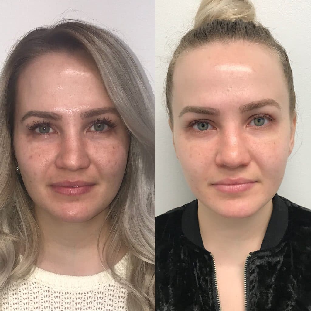 Before and after images showing the results of a facial esthetic treatment.