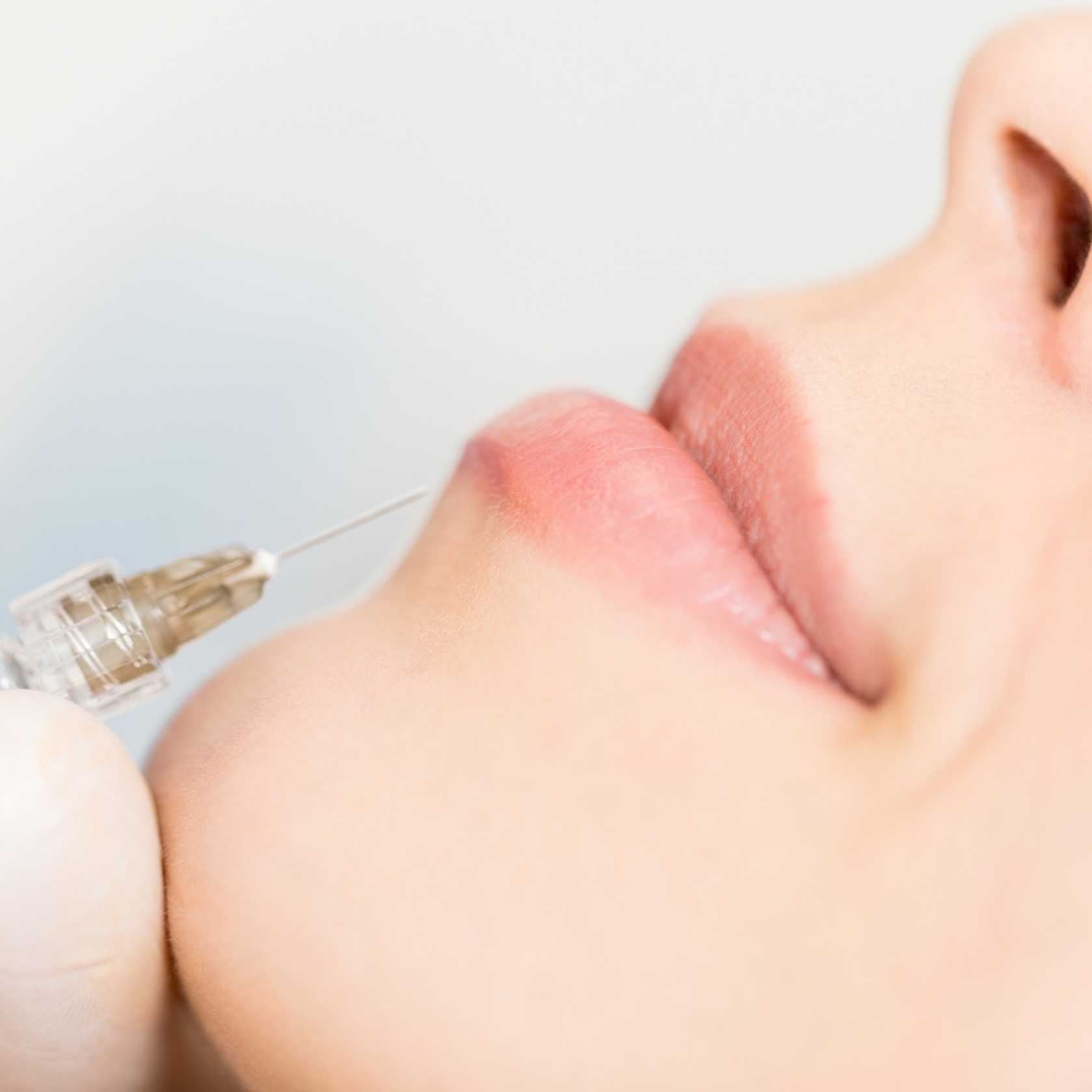 Syringe being used to administer dermal filler in a facial treatment.