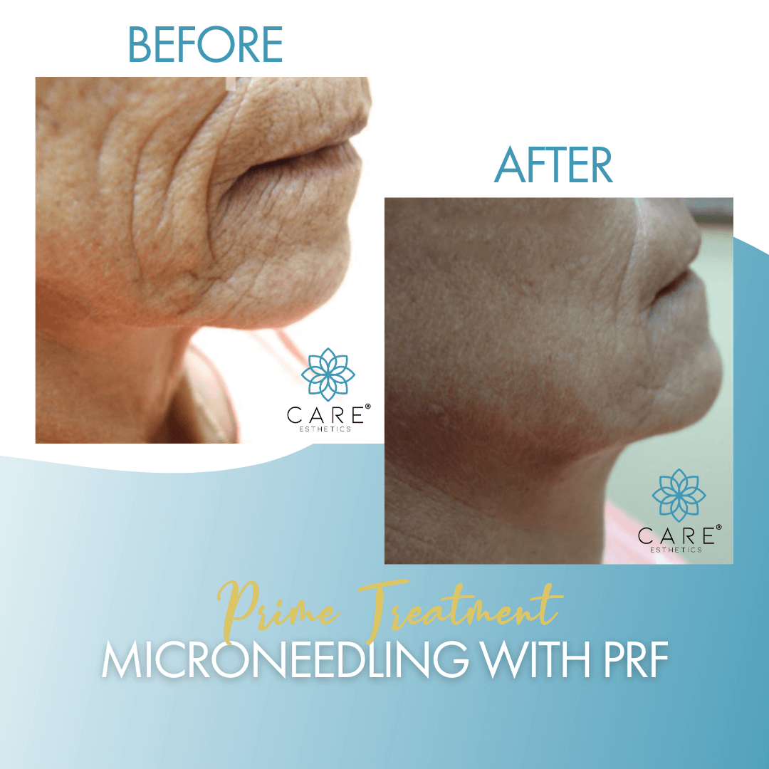 prime-microneedling-prf-img