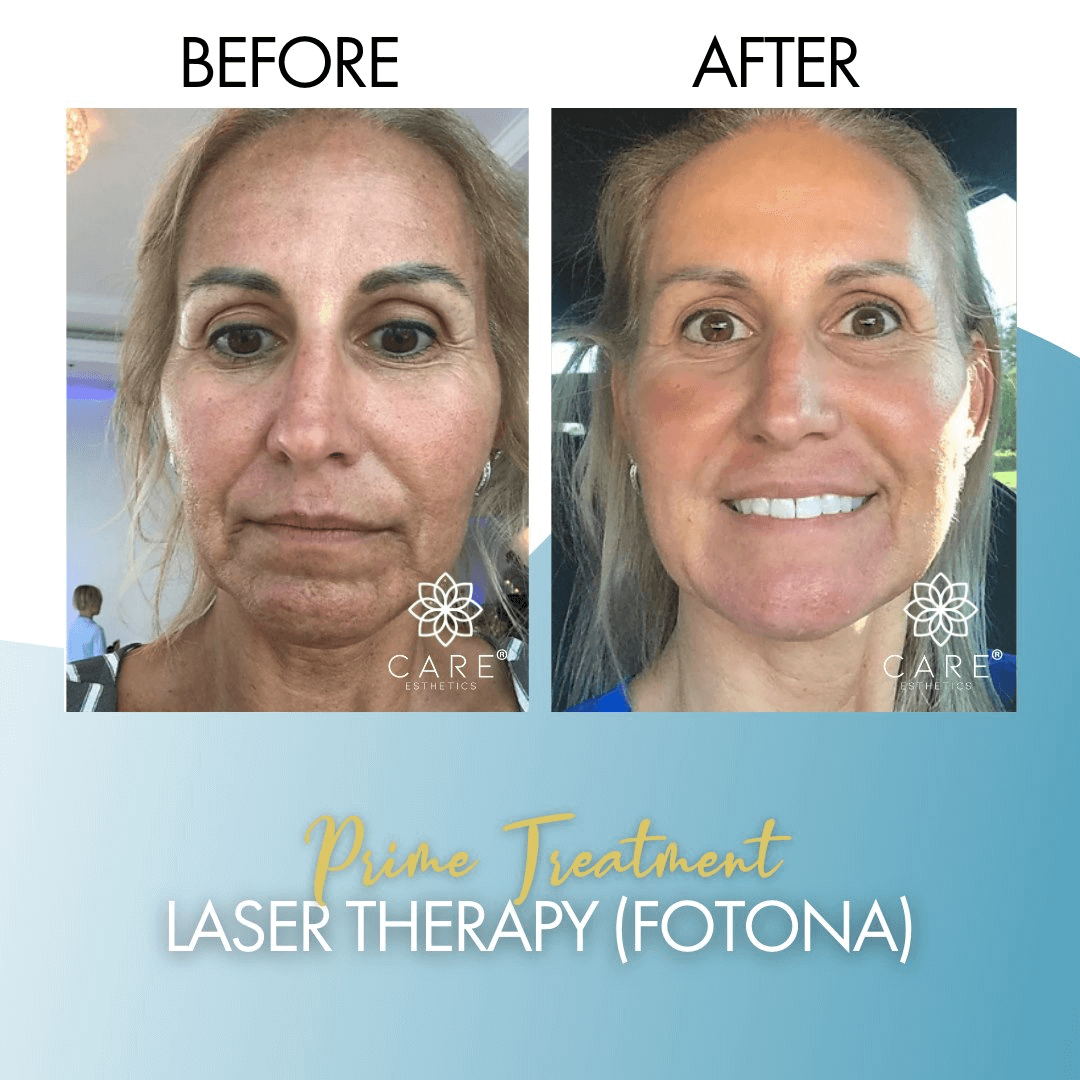 We offer our Fotona laser therapy to help people just like you