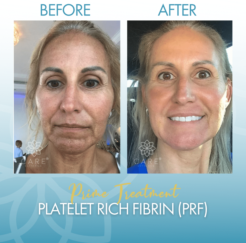 PRF Filler Before and After 01