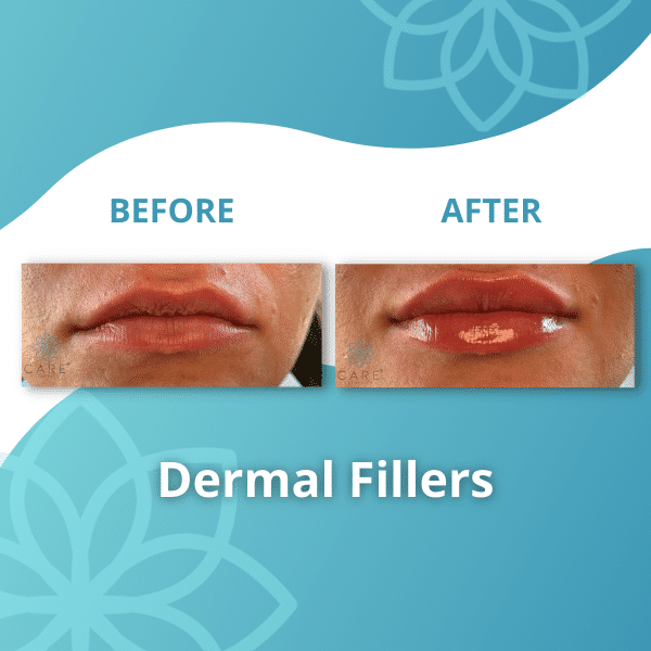 dermal fillers2