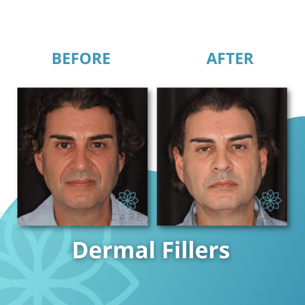 dermalfillers1