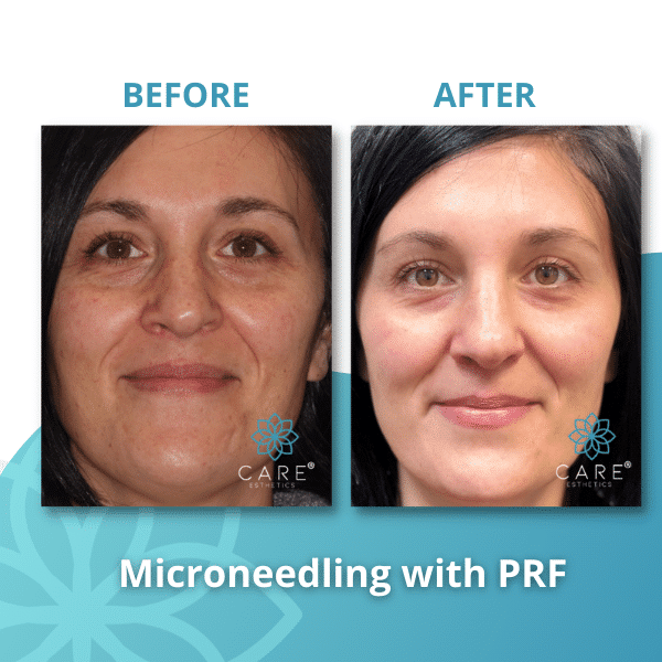 microneedling prf