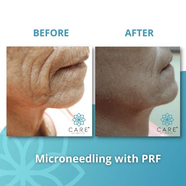 microneedling prf2