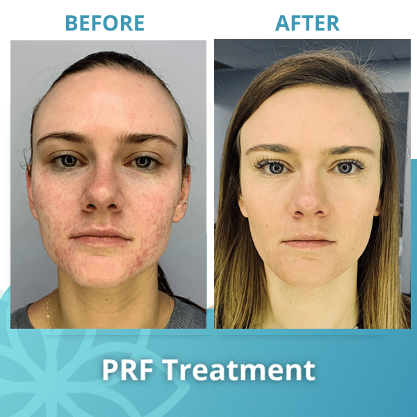 prf treatment before after