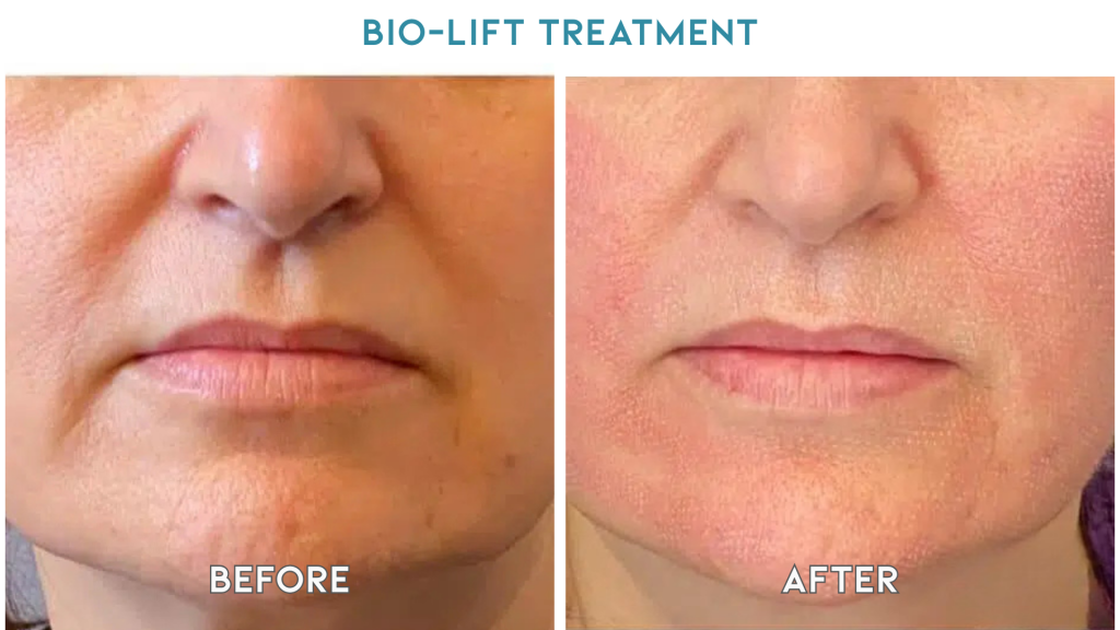bio lift