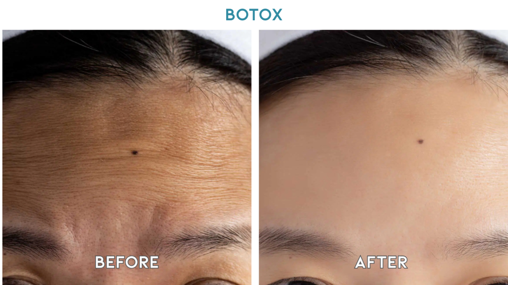 botox