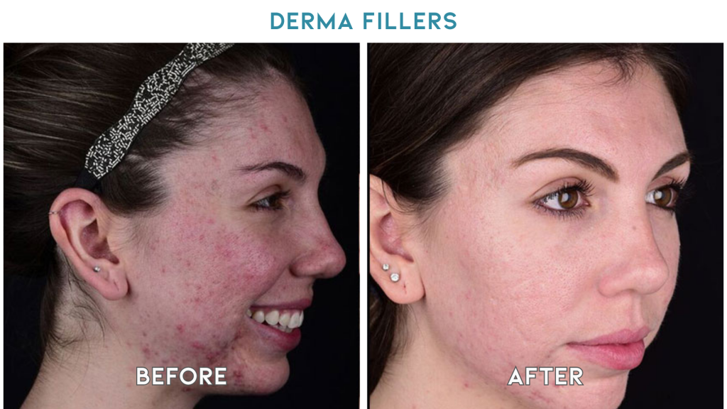 derma fillers