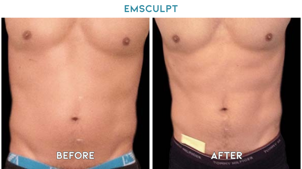 emsculpt