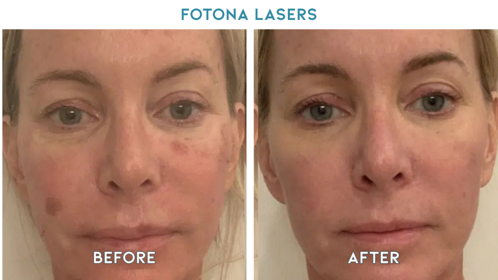 fotona lasers