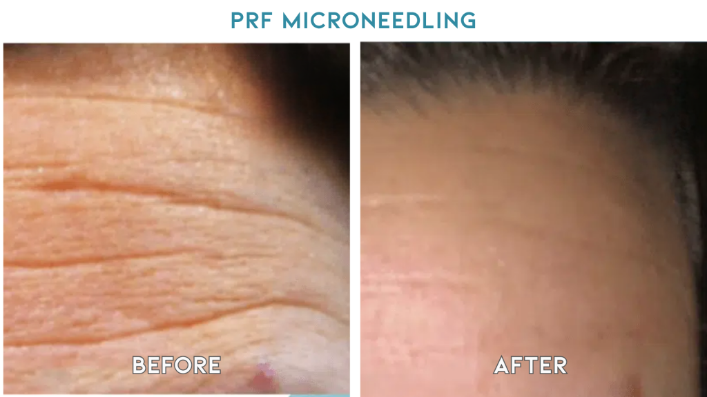 prf microneedling